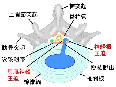 糖尿病の勃起不全の原因