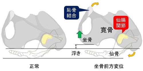 正常な骨盤と坐骨前方変位した骨盤