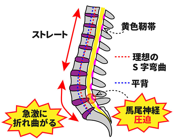 平背による脊柱管狭窄症