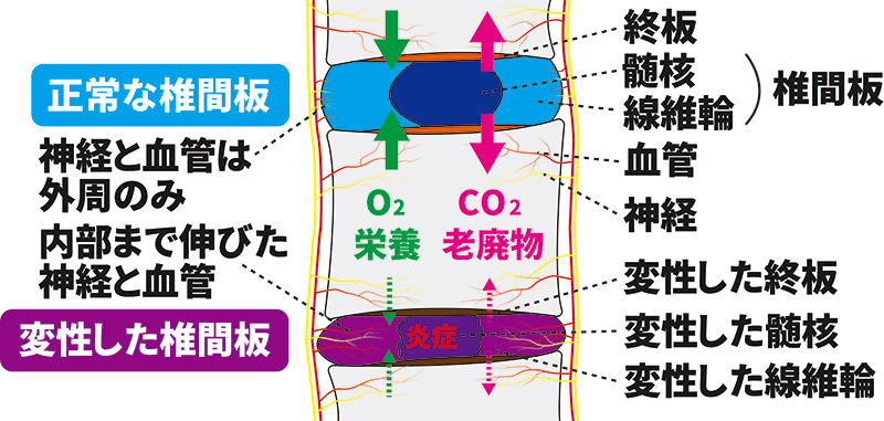 椎間板変性症(正常な椎間板と変性した椎間板)